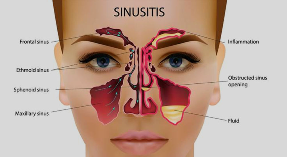 Sinusitis